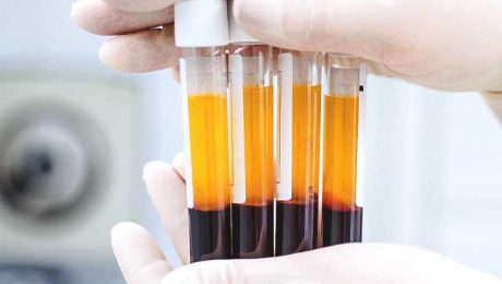 Platelet-Rich Plasma for hair loss